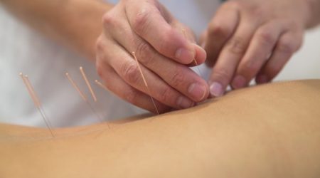 acupunctuur acupunctuur